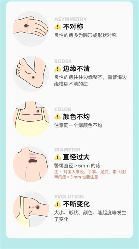 身上有很多痣|痣也可能会癌变！长在 3 个地方要注意